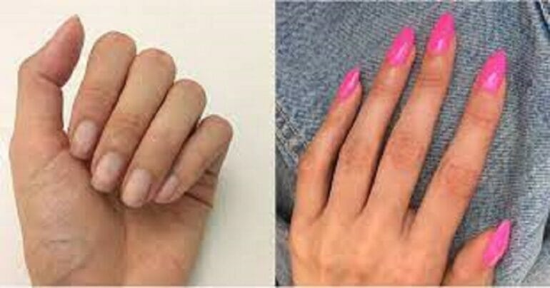 Why Do Nails Grow Faster With Acrylic?