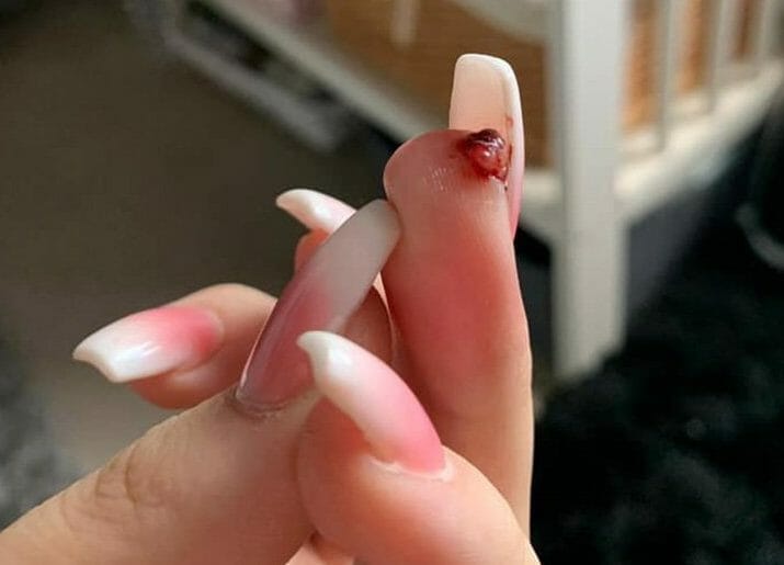 are acrylic nails inserted under the skin
